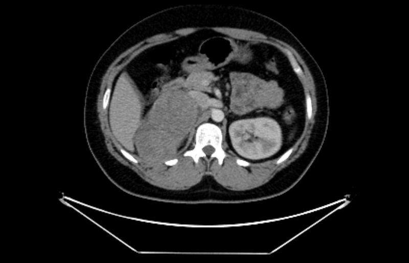 File:Adrenocortical carcinoma (Radiopaedia 80134-93438 Axial C+ portal venous phase 48).jpg