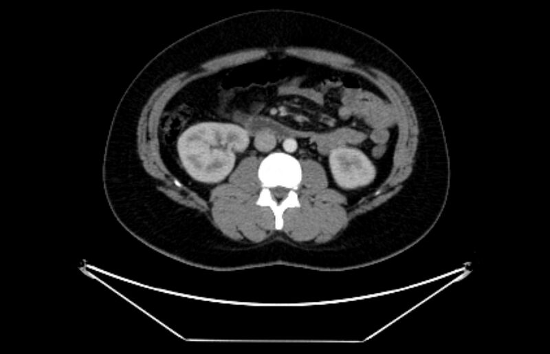 File:Adrenocortical carcinoma (Radiopaedia 80134-93438 Axial C+ portal venous phase 64).jpg
