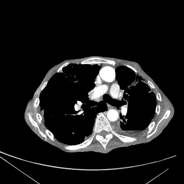 File:Advanced pulmonary tuberculosis (Radiopaedia 8599-9431 Axial liver window 9).jpg