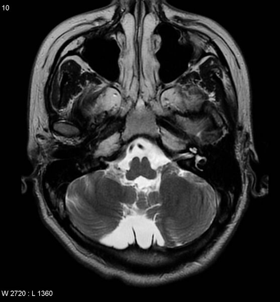 File:Aicardi syndrome (Radiopaedia 5353-7117 Axial T2 5).jpg
