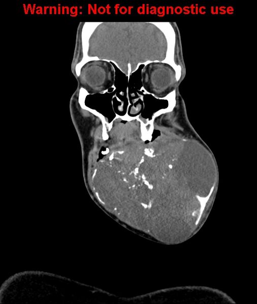 File:Ameloblastoma (Radiopaedia 33126-34164 D 20).jpg