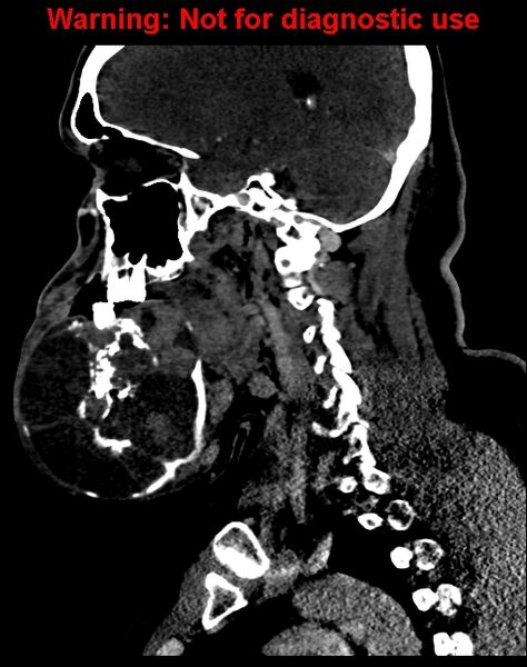 File:Ameloblastoma (Radiopaedia 33126-34164 F 29).jpg