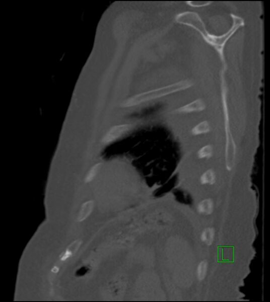 File:Amiodarone deposition in the liver (Radiopaedia 77587-89780 Sagittal bone window 20).jpg