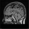 Amnestic syndrome secondary to hypoxic brain injury (Radiopaedia 24743-25004 D 10).jpg