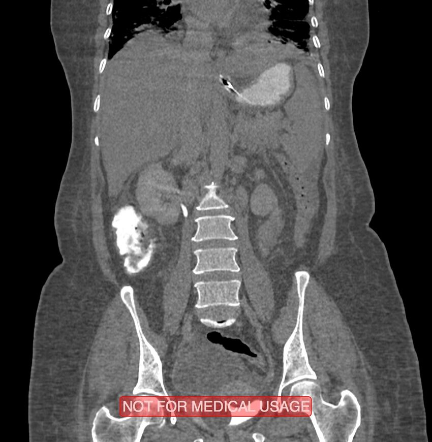 Amoebic enterocolitis with liver abscess (Radiopaedia 35100-36609 B 116).jpg