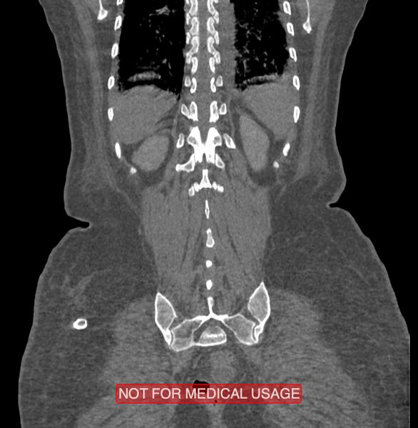 File:Amoebic enterocolitis with liver abscess (Radiopaedia 35100-36609 B 175).jpg
