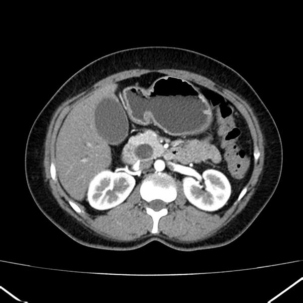 File:Ampullary tumor (Radiopaedia 22787-22816 B 35).jpg