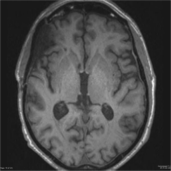 File:Anaplastic meningioma with recurrence (Radiopaedia 34452-35788 Axial T1 68).jpg