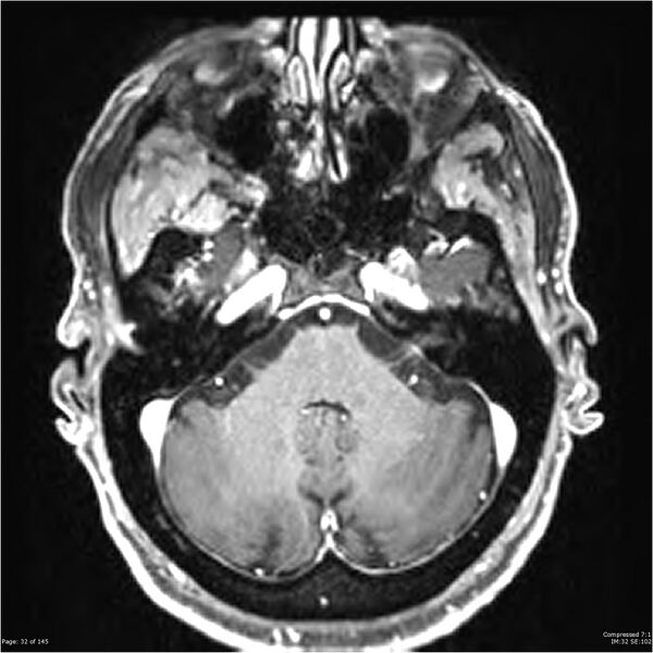 File:Anaplastic meningioma with recurrence (Radiopaedia 34452-35788 Axial T1 C+ 32).jpg