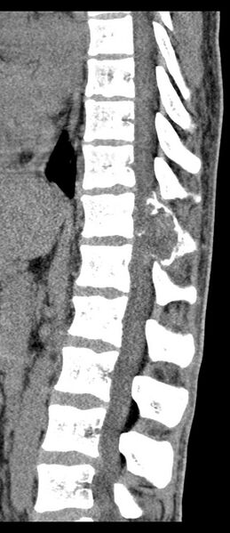 File:Aneurysmal bone cyst T11 (Radiopaedia 29294-29721 E 41).jpg