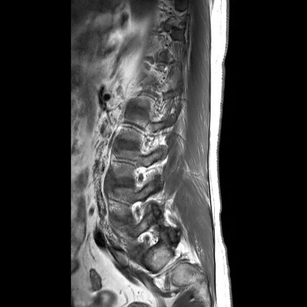File:Ankylosing spondylitis with zygapophyseal arthritis (Radiopaedia 38433-40516 Sagittal T1 1).jpg