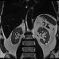 Annular pancreas (Radiopaedia 38292-40320 Coronal T2 4).png