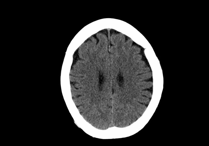 File:Anomalous intracranial venous drainage (Radiopaedia 28161-28418 Axial non-contrast 31).jpg