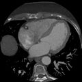 Anomalous origin of left circumflex artery from right coronary sinus (Radiopaedia 72563-83117 A 26).jpg