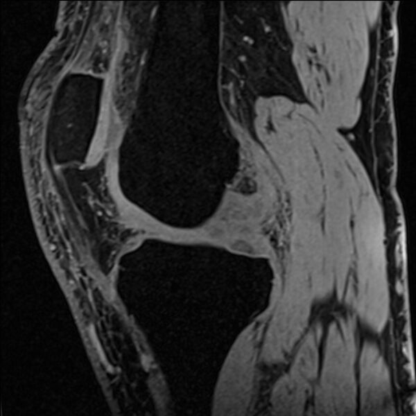 File:Anterior cruciate ligament tear - ramp lesion (Radiopaedia 71883-82322 Sagittal T1 vibe 85).jpg