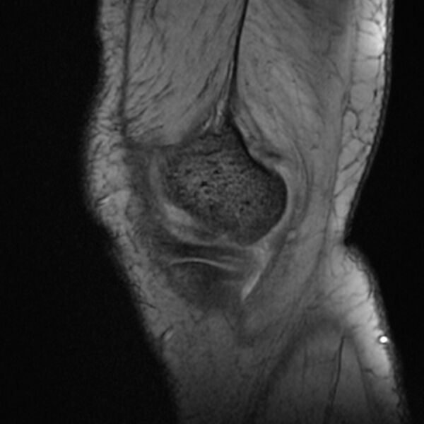 File:Anterior cruciate ligament tear - ramp lesion (Radiopaedia 71883-82322 Sagittal T2 fat sat 22).jpg