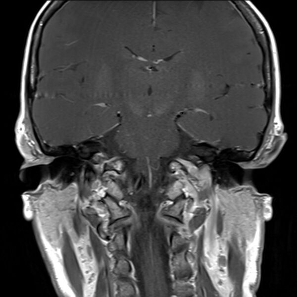 File:Anterior temporal encephalocele (Radiopaedia 82624-96808 Coronal T1 12).jpg