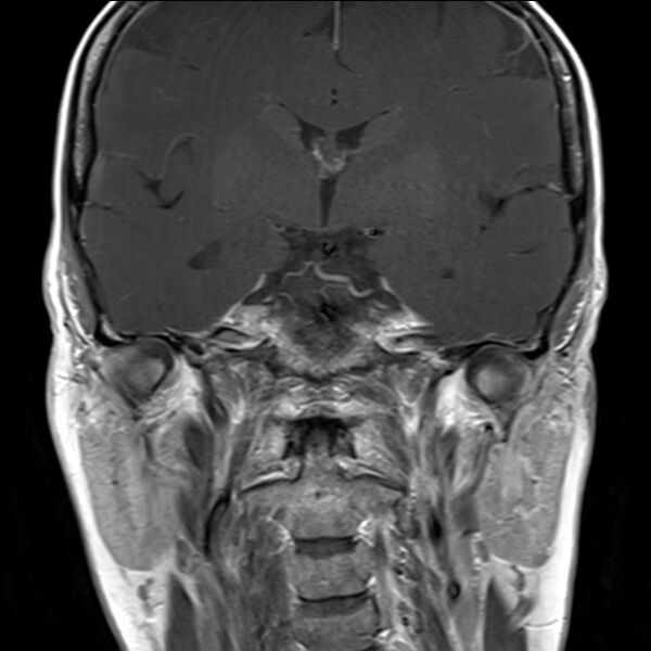 File:Anterior temporal encephalocele (Radiopaedia 82624-96808 Coronal T1 9).jpg