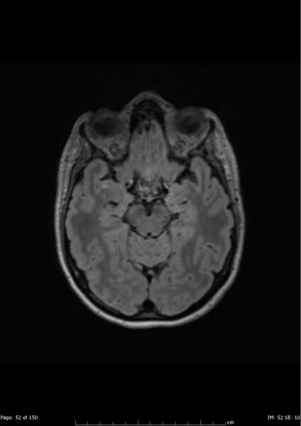 File:Anterior temporal lobe perivascular space (Radiopaedia 40946-43650 Axial FLAIR 13).jpg