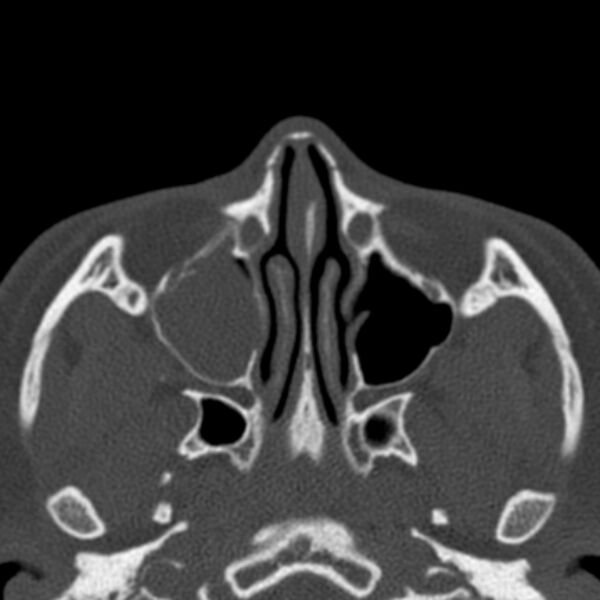 File:Antrochoanal polyp (Radiopaedia 33984-35202 Axial bone window 34).jpg