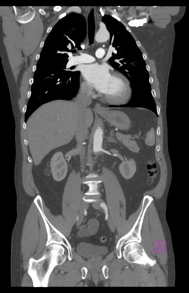 File:Aortectomy and axillary-bifemoral bypass (Radiopaedia 28303-28545 C 49).jpg