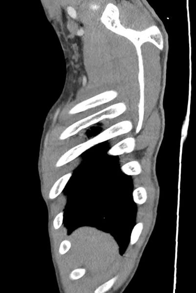 File:Aortic coarctation with aneurysm (Radiopaedia 74818-85828 B 20).jpg