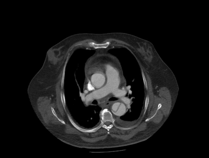 File:Aortic dissection (Radiopaedia 28802-29105 A 16).jpg