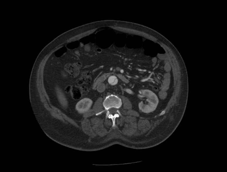 File:Aortic dissection (Radiopaedia 28802-29105 A 61).jpg