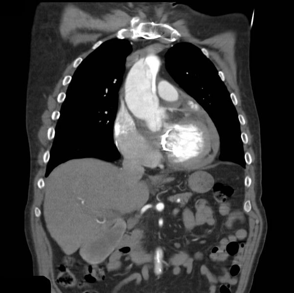 File:Aortic dissection with rupture into pericardium (Radiopaedia 12384-12647 B 15).jpg