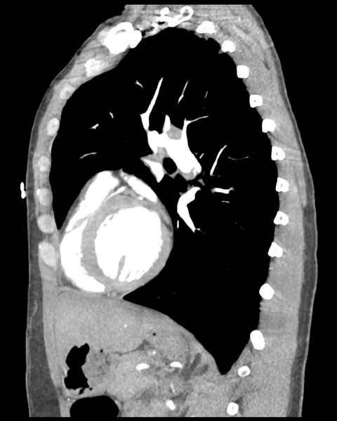 File:Aortic valve non-coronary cusp thrombus (Radiopaedia 55661-62189 D 22).png