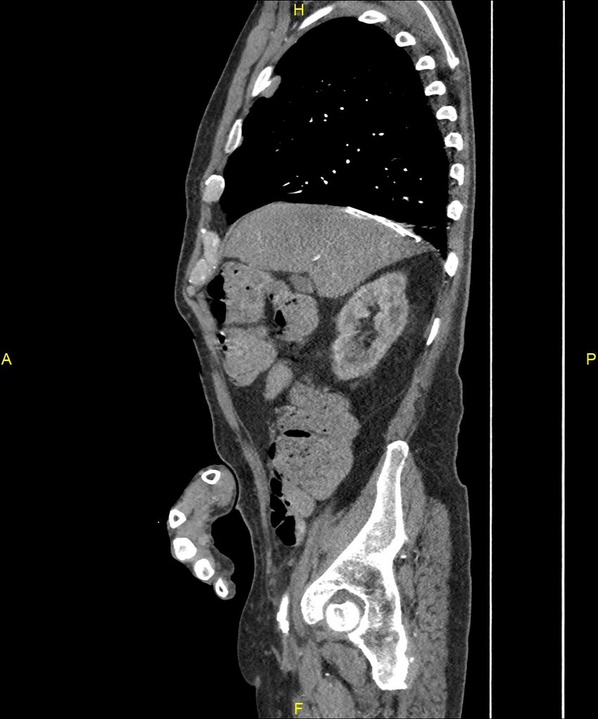 Aortoenteric fistula (Radiopaedia 84308-99603 C 95).jpg
