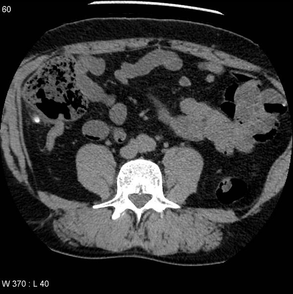 File:Appendicitis (Radiopaedia 12510-12733 Axial non-contrast 27).jpg
