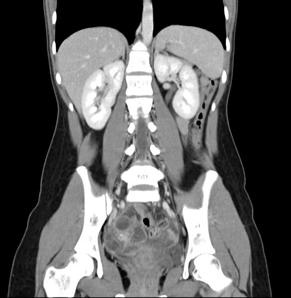 File:Appendicitis and incidental bicornuate uterus (Radiopaedia 22833-22853 D 27).jpg