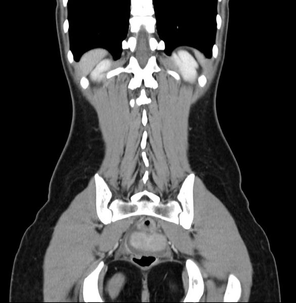 File:Appendicitis and incidental bicornuate uterus (Radiopaedia 22833-22853 D 38).jpg