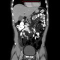 Appendicitis and renal cell carcinoma (Radiopaedia 17063-16760 B 10).jpg