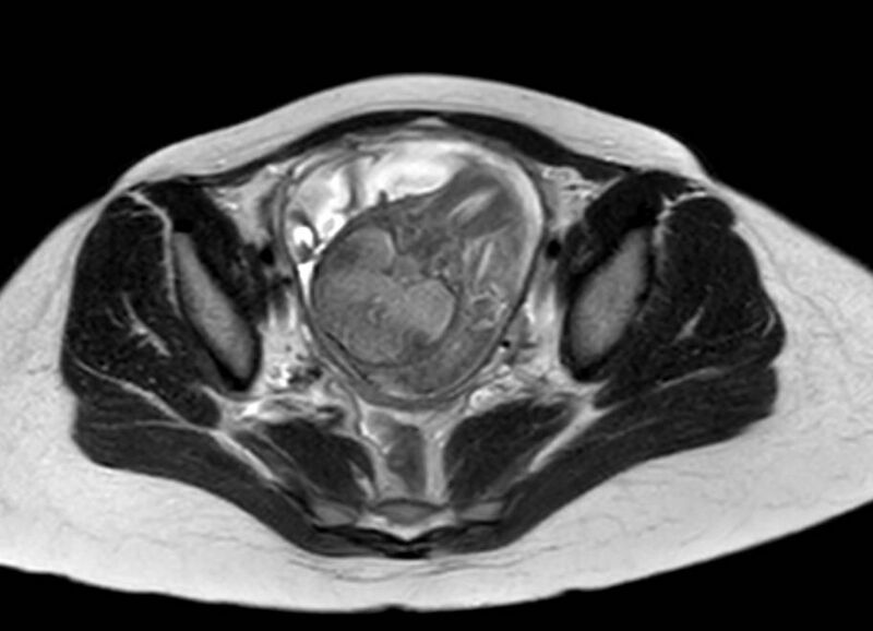 File:Appendicitis in gravida (MRI) (Radiopaedia 89433-106395 Axial T2 59).jpg