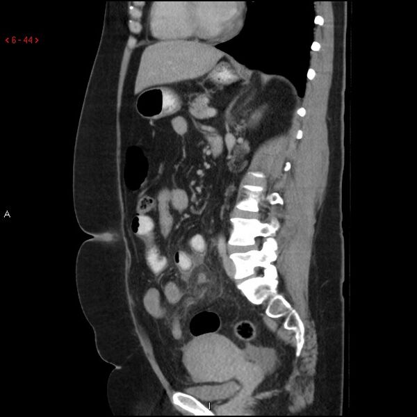 File:Appendicitis with microperforation- promontoric type (Radiopaedia 27268-27442 A 29).jpg