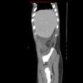 Appendicitis with phlegmon (Radiopaedia 9358-10046 F 2).jpg
