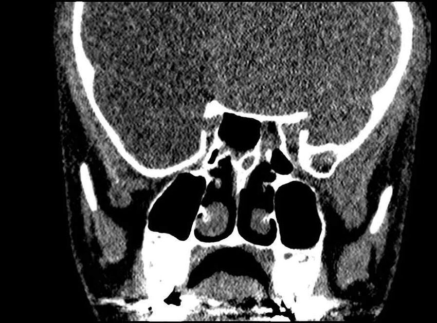 Arachnoid cyst- extremely large (Radiopaedia 68741-78450 Coronal bone window 33).jpg