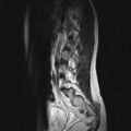 Arachnoid cyst - spinal (Radiopaedia 66835-76157 Sagittal T2 1).jpg