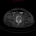Arachnoiditis ossificans (Radiopaedia 51394-57136 Axial bone window 25).jpg