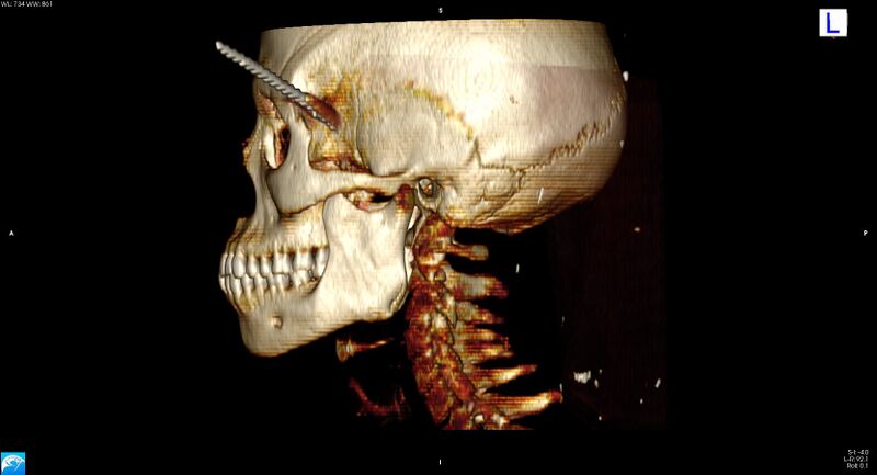 File:Arrow injury to the head (Radiopaedia 75266-86388 3D horizontal 22).jpg