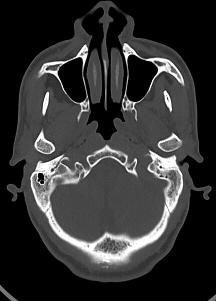 File:Arrow injury to the head (Radiopaedia 75266-86388 Axial bone window 46).jpg