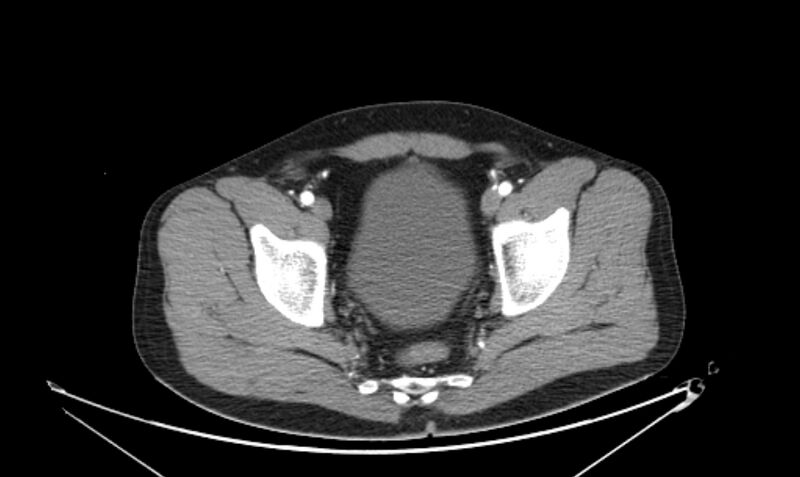 File:Arterial occlusive mesenteric ischemia (Radiopaedia 84641-100060 A 117).jpg