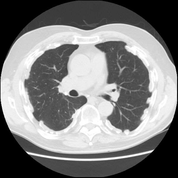 File:Asbestos-related pleural plaques (Radiopaedia 39069-41255 Axial lung window 35).jpg