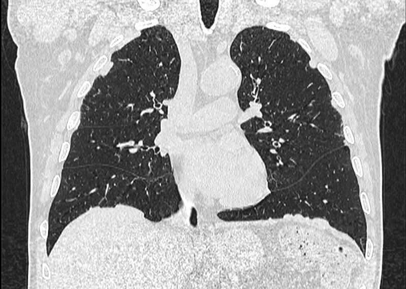 File:Asbestos pleural placques (Radiopaedia 57905-64872 Coronal lung window 129).jpg