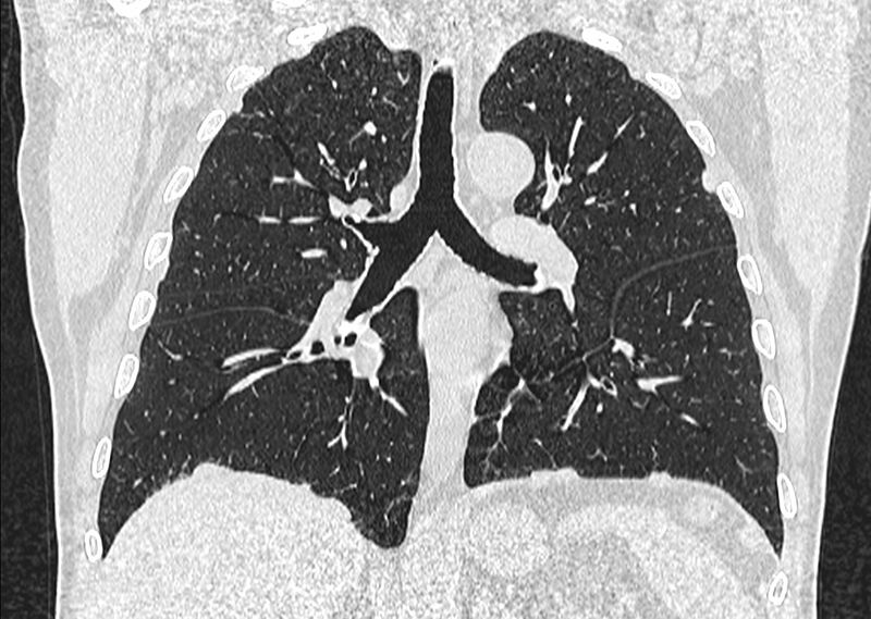 File:Asbestos pleural placques (Radiopaedia 57905-64872 Coronal lung window 161).jpg