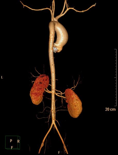 File:Ascending aortic pseudoaneurysm (Radiopaedia 28638-28910 D 16).jpg
