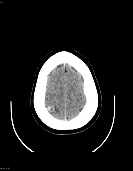 File:Astroblastoma (Radiopaedia 39792-42216 Axial non-contrast 43).jpg