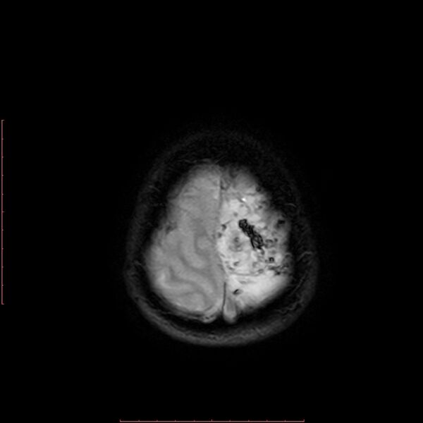File:Astroblastoma (Radiopaedia 74287-85162 Axial SWI 21).jpg